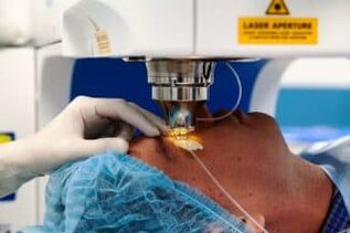 Laser vision surgery