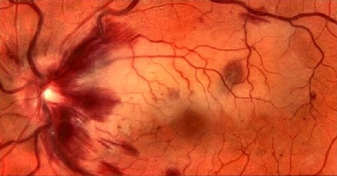 retinal blood vessels and restore vision