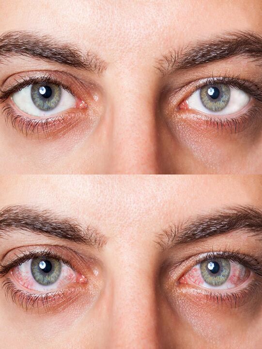 before and after treatment with drops Oculear